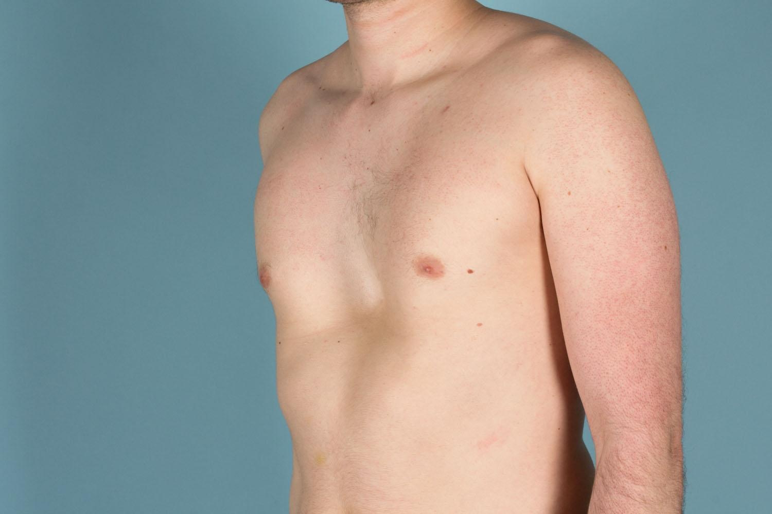 Patient with Pectus Excavatum